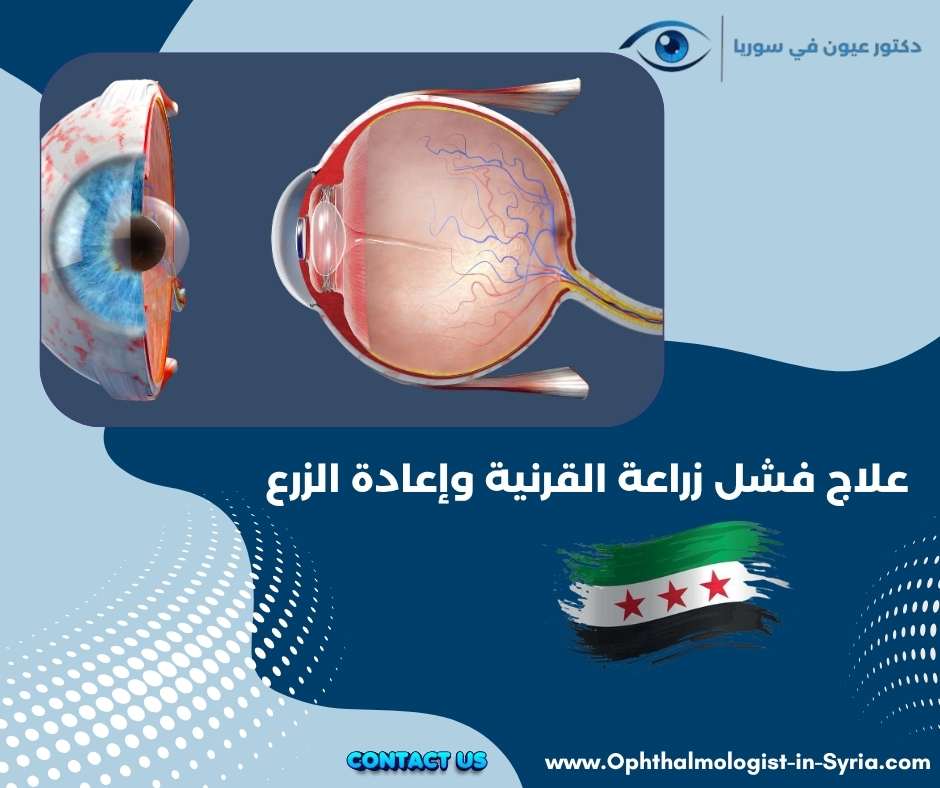 علاج فشل زراعة القرنية وإعادة الزرع